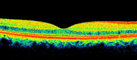 optical coherence tomography
