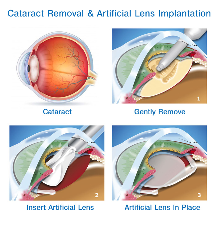 What happens during Cataract Surgery
