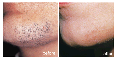 Chin hair removal before and after