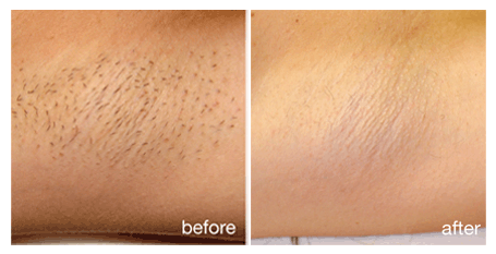 Underarm hair removal before and after