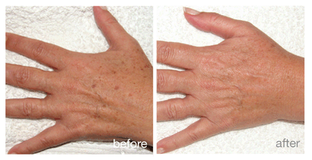 Age And Sun Spot Treatment Hands before and after