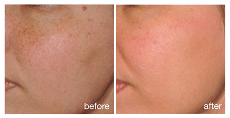 Pigmentation And Freckles Treatment before and after