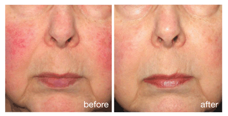 Rosacea and photorejuvenation treatment before and after