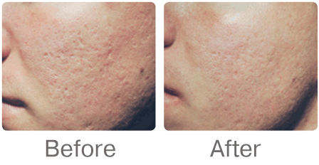 Microneedling acne scars before and after