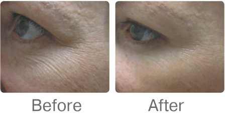 Microneedling virtually erasing wrinkles around the eyes before and after