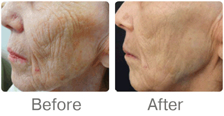 Microneedling virtually erasing wrinkles before and after