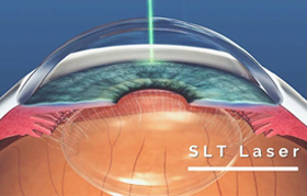SLT Laser Treatment For Glaucoma