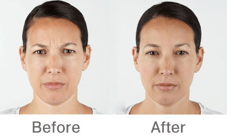 anti-wrinkle Botox treatments before and after