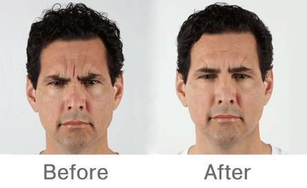 anti-wrinkle Botox injections before and after