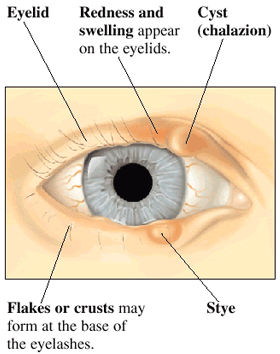 Blepharitis treatment and diagnosis in Brantford, Ontario