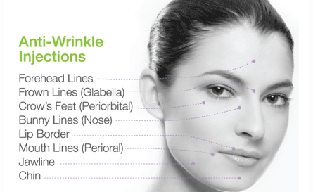 Botox anti-wrinkle injection treatments in Brantford, Ontario by Dr. Fadi Calotti