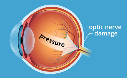 Damage from elevated intraocular pressure