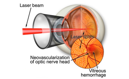 Retinal laser treatments in Brantford, Ontario