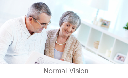 Vision without Glaucoma