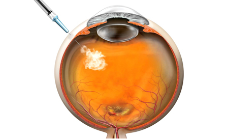 Intravitreal ocular anti-VEGF injection treatments in Brantford, Ontario 